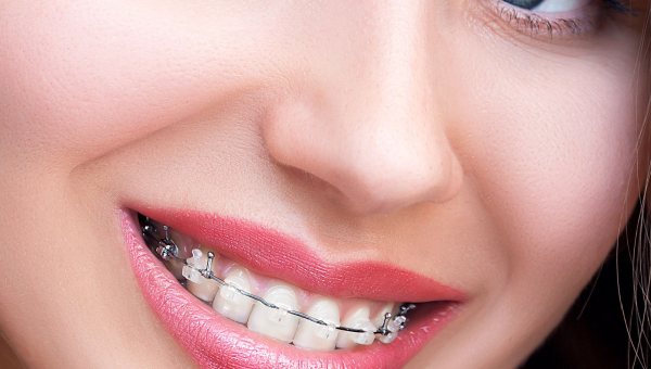 Ceramic Braces from your South Houston Dentist