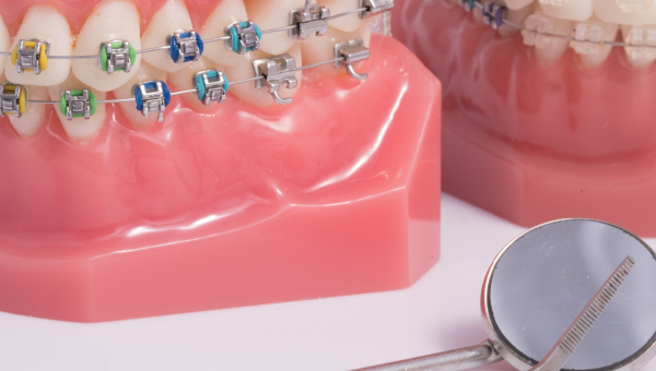 Ceramic vs metal braces