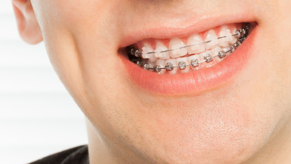 A man wearing ceramic braces
