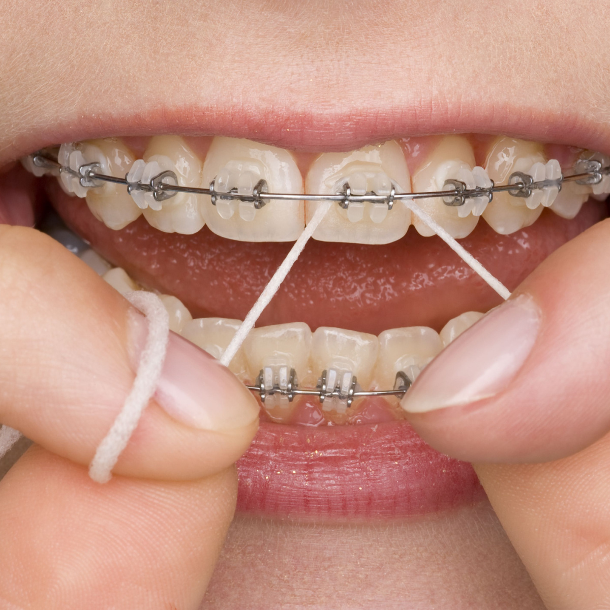 A patient with braces flossing