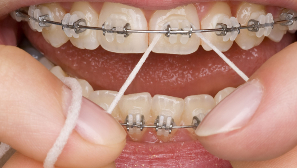 Maintaining Oral Hygiene with Metal Houston Braces