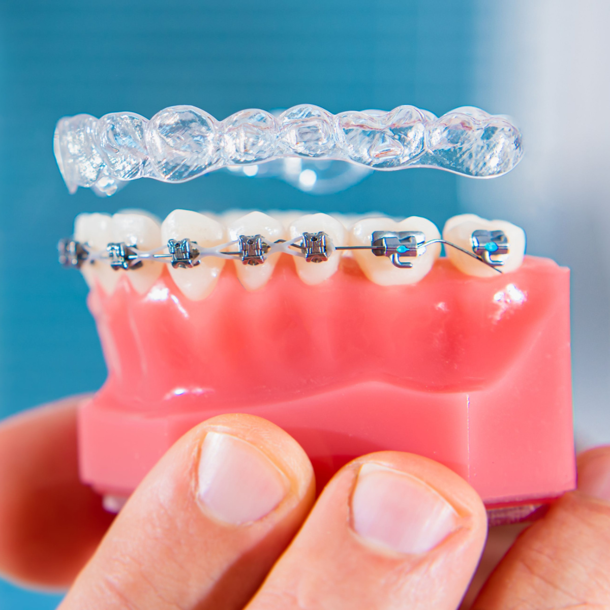 Two different types of Houston braces that you can get from your Houston dentist. Find out the difference between metal braces, ceramic braces, and Invisalign.
