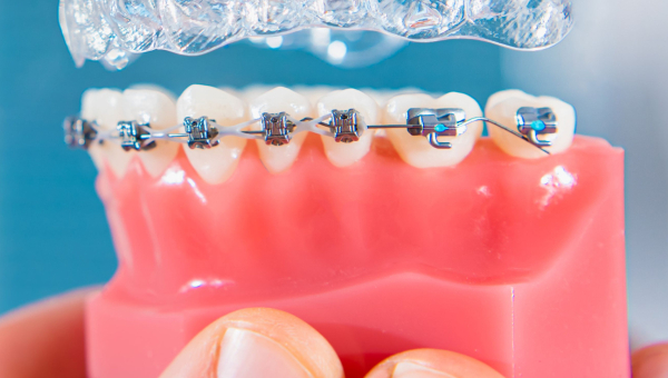 A Comprehensive Guide to Different Types of Houston Braces