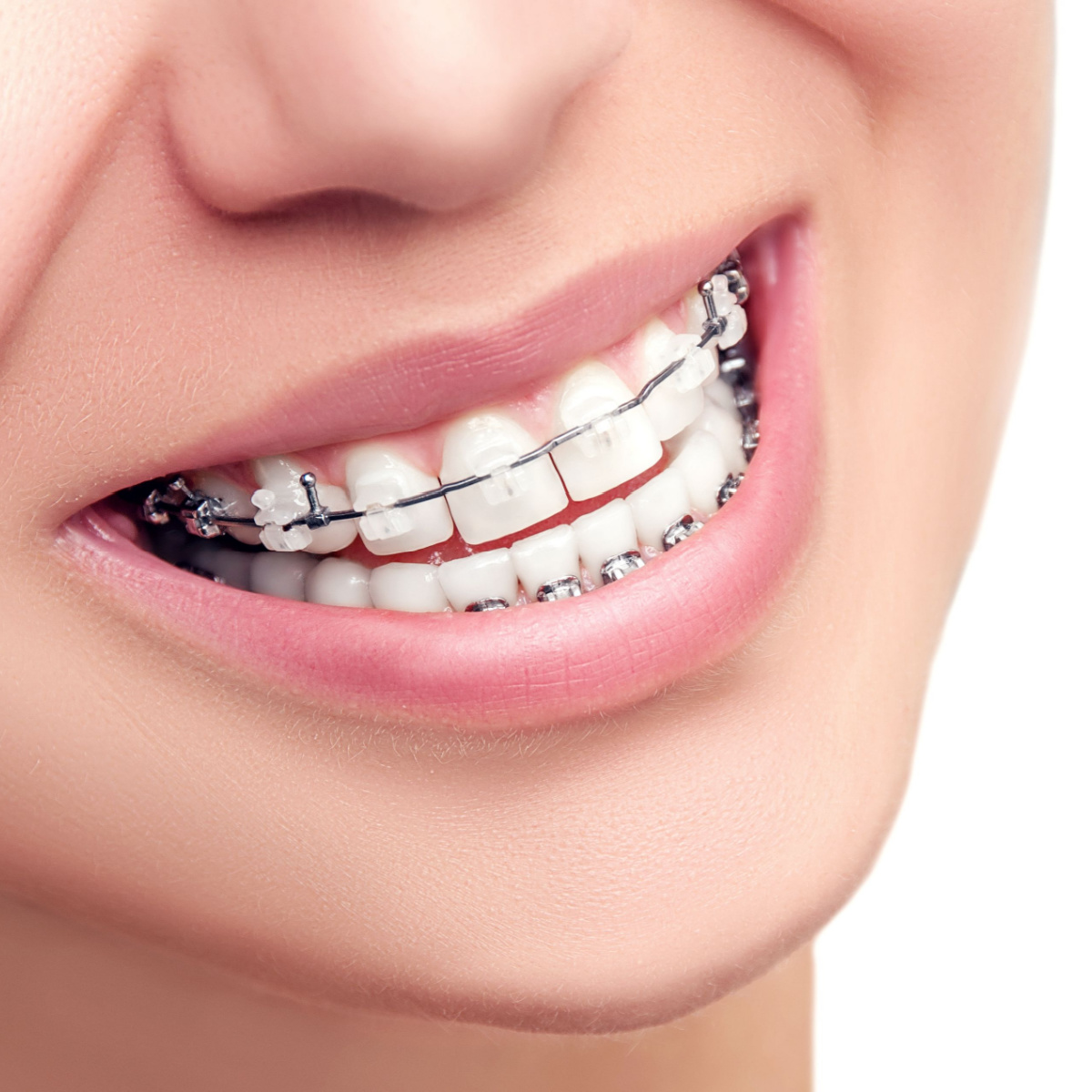 When to Consider Houston Ceramic Braces for Your Child