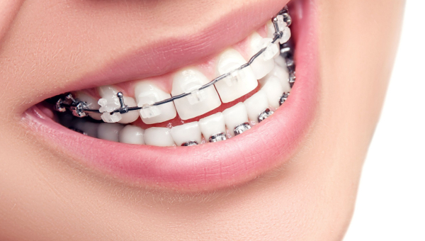 Houston ceramic braces
