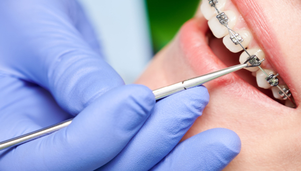 A Houston dentist adjusting dental braces