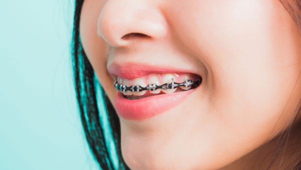 Lady with Houston dental brace flashed her pearly whites.