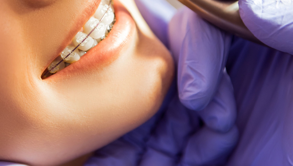 Maintaining proper hygiene with Houston braces