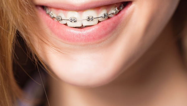 Lady shows her clean South Houston braces with a smile.