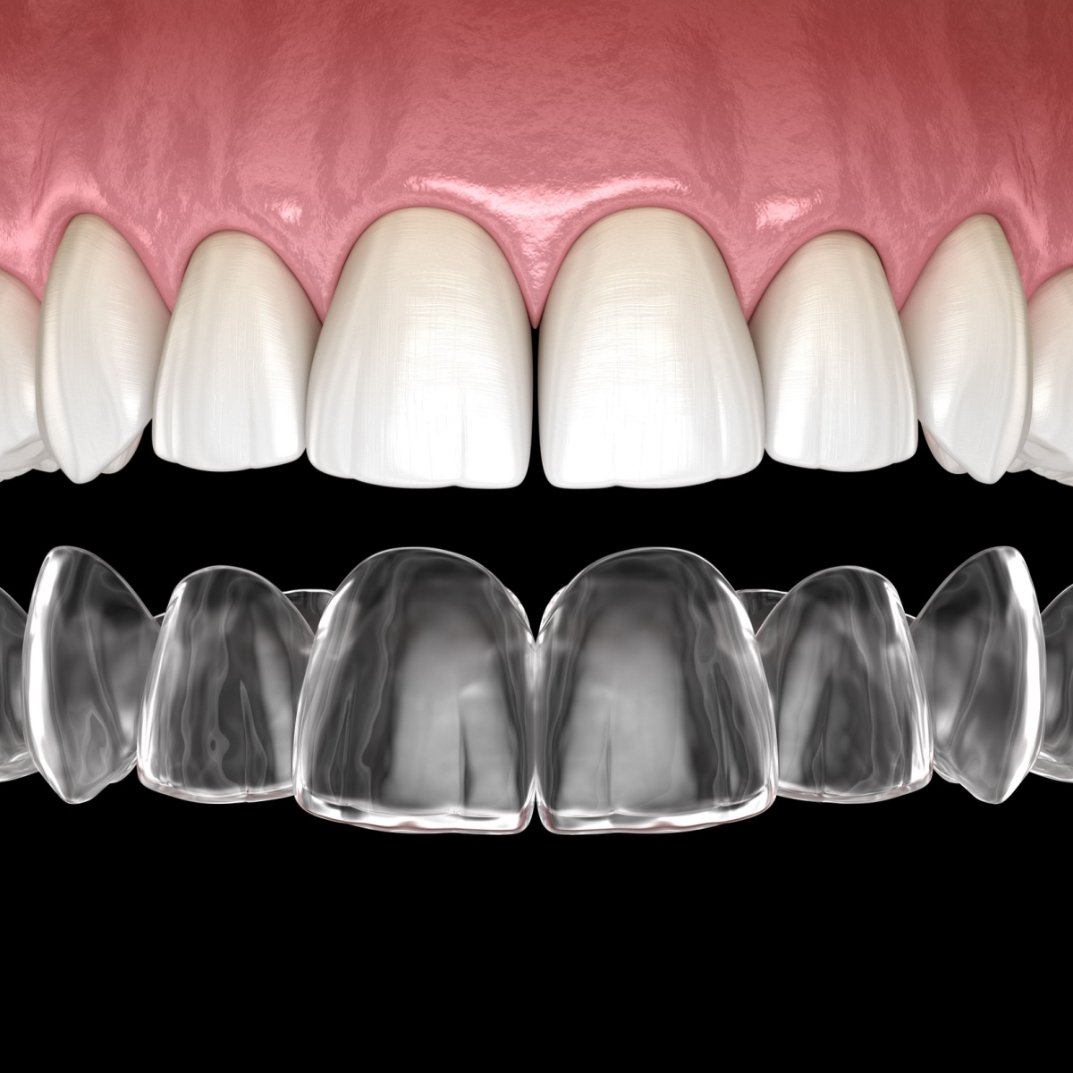 How Houston Invisalign braces work