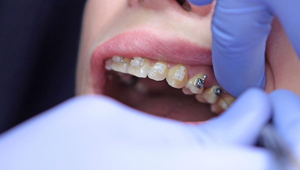 Choosing the right type of Houston braces