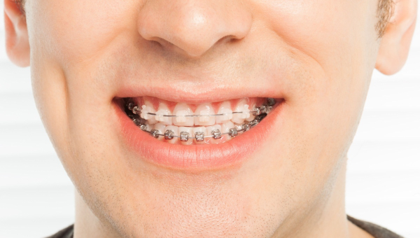 How to choose between ceramic or metal South Houston braces