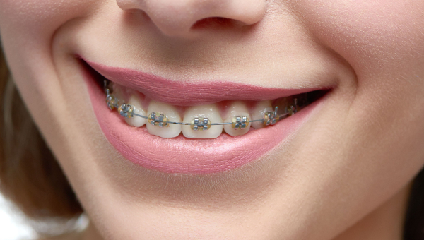 Use these tips to care for your South Houston braces.