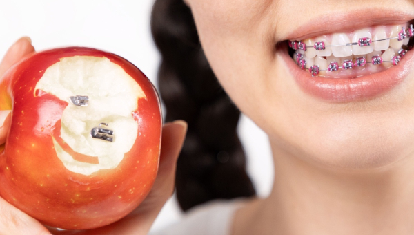 Maintaining oral hygiene with Houston braces