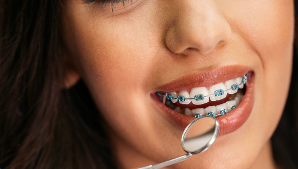 How long do you need Houston braces?