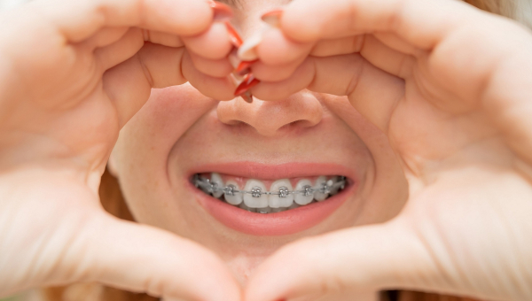 Find the right type of South Houston braces for your perfect smile.