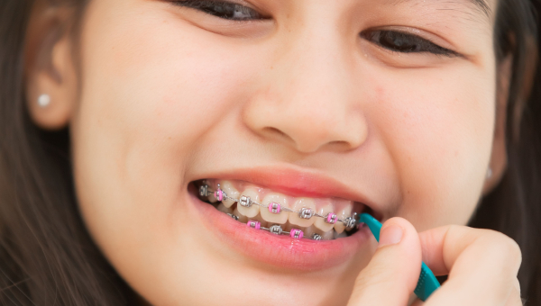 Develop these hygiene habits to keep your South Houston braces in perfect condition.