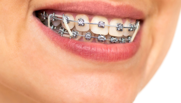 A closeup of elastics with Houston braces