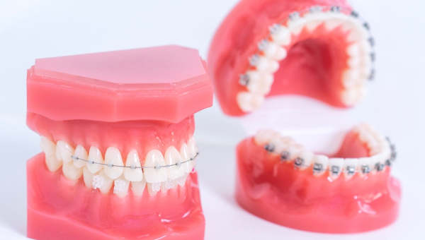 Ceramic vs metal South Houston braces