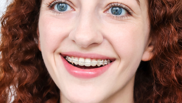 Here’s a short primer discussing your South Houston braces options.