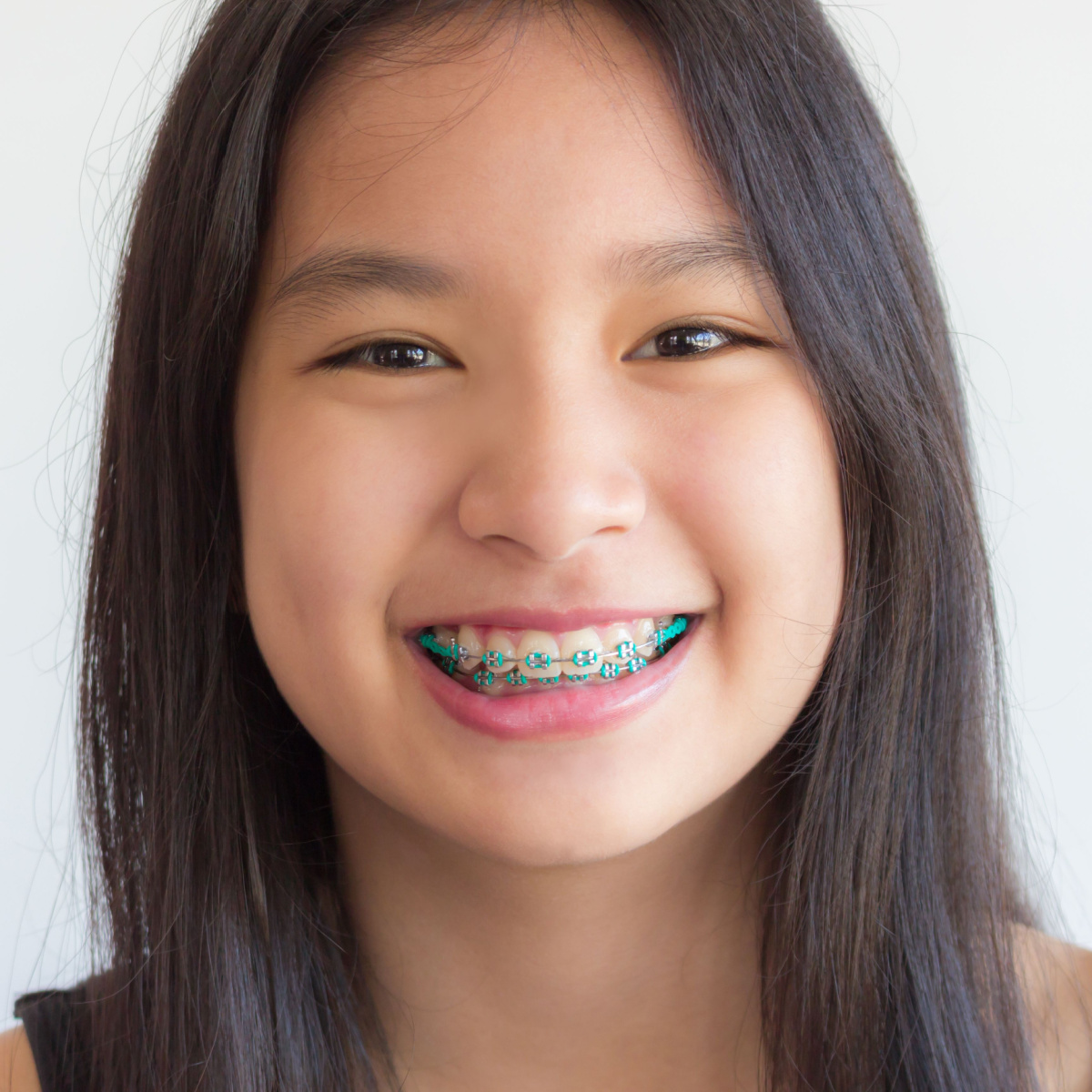 This article can help you decide with Houston braces to get.