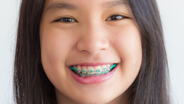 This article can help you decide with Houston braces to get.