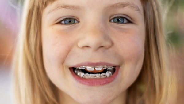 Consult your Houston dentist to determine the best age to get braces for your child.