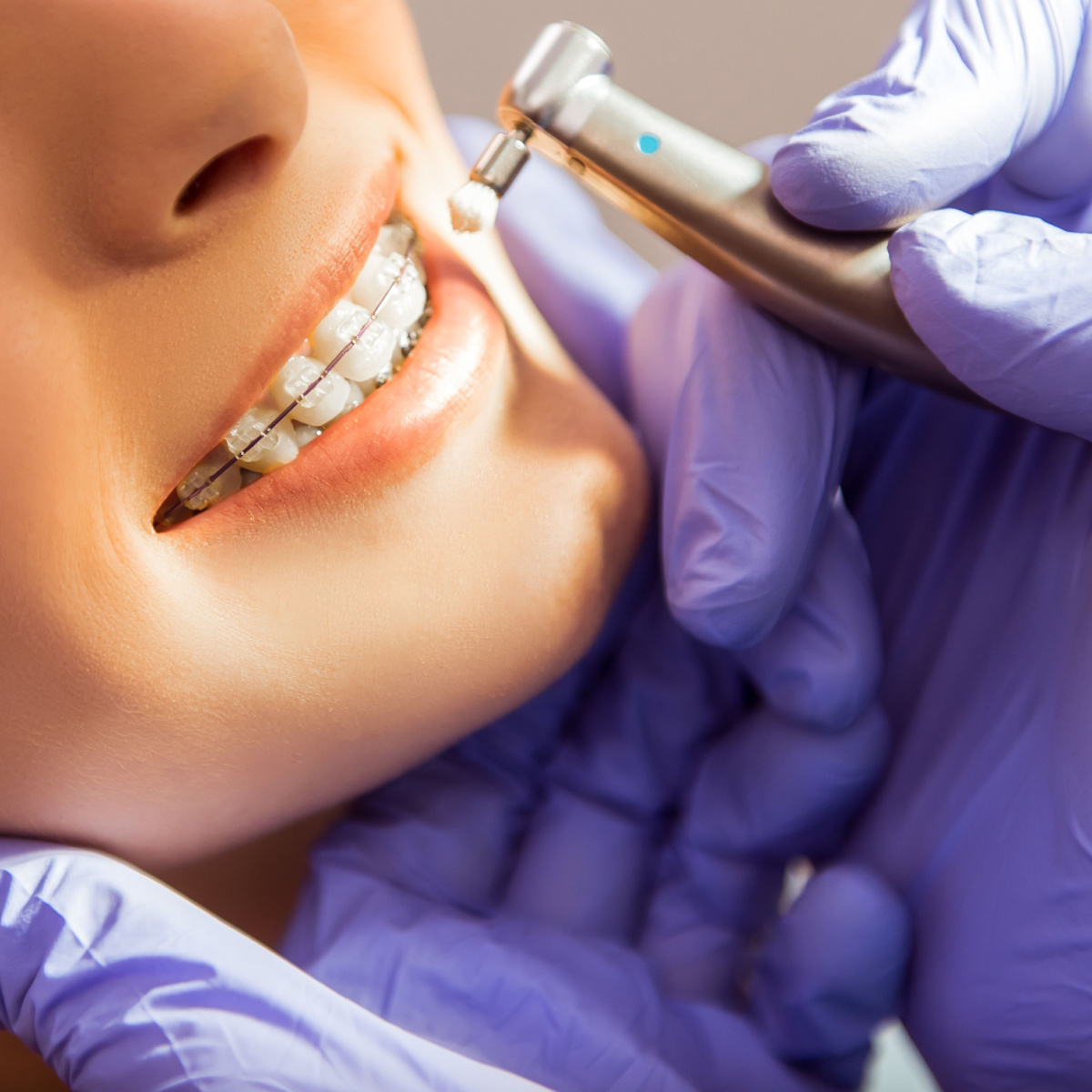 Maintaining proper hygiene with Houston braces