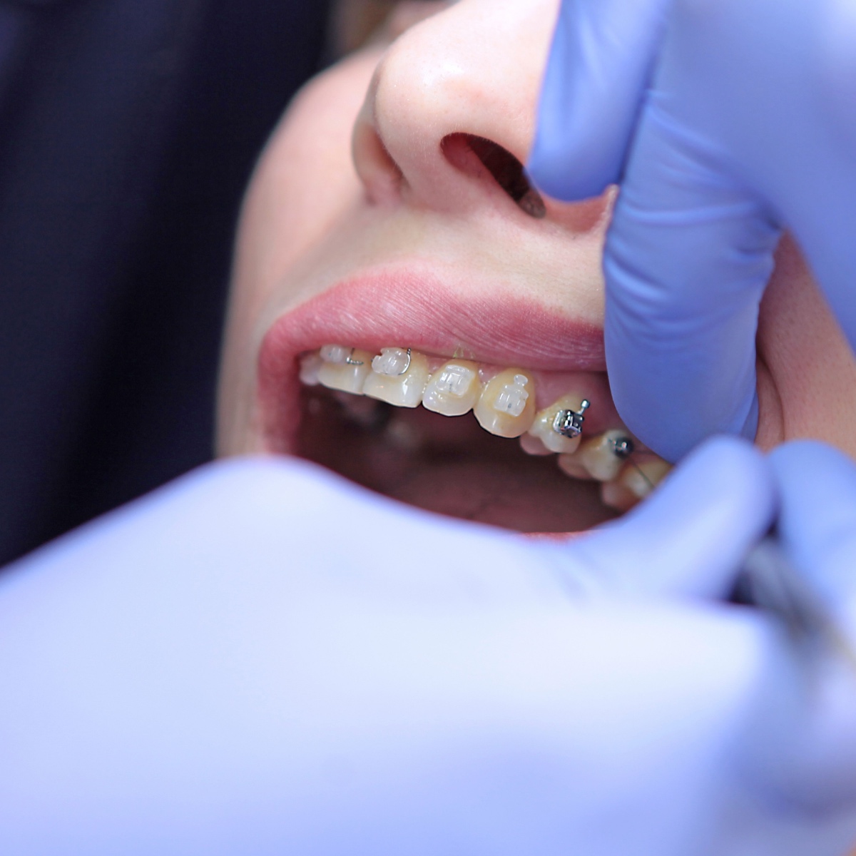 Choosing the right type of Houston braces