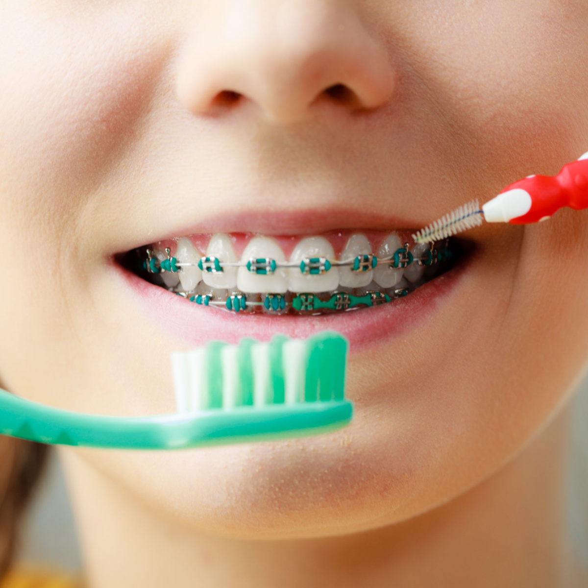 Cleaning dental braces