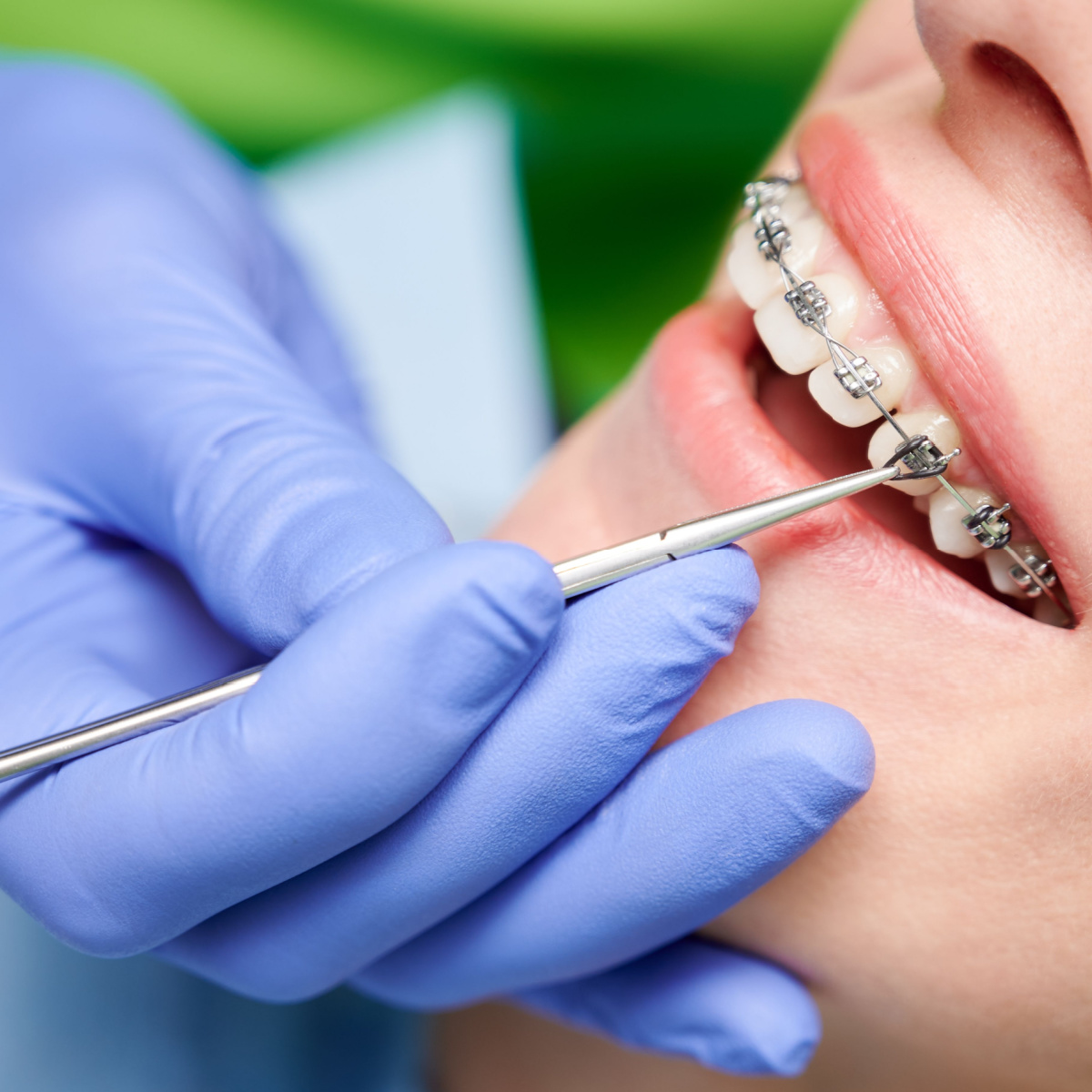 A Houston dentist adjusting dental braces