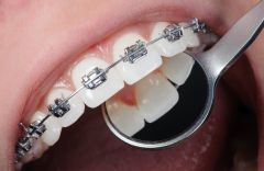 Adults Should Get Houston Braces, Too