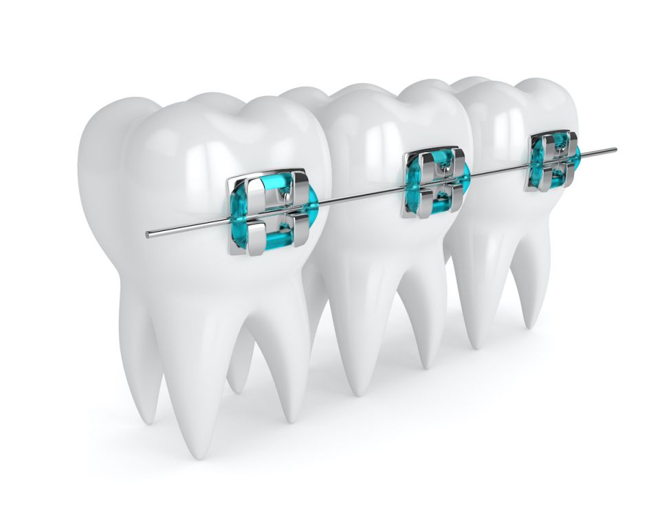What To Expect With Metal And Ceramic Houston Braces
