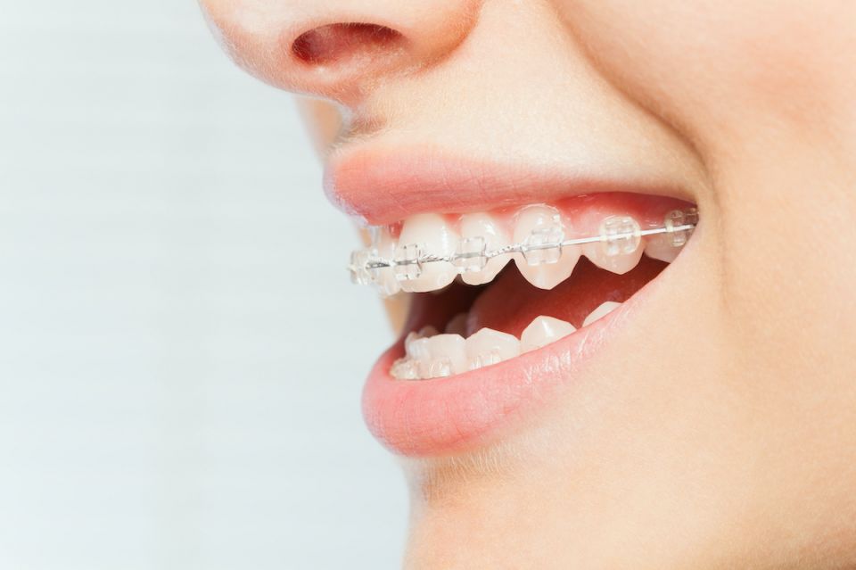 Centra Dental in South Houston Offers Ceramic Houston Braces For Adults