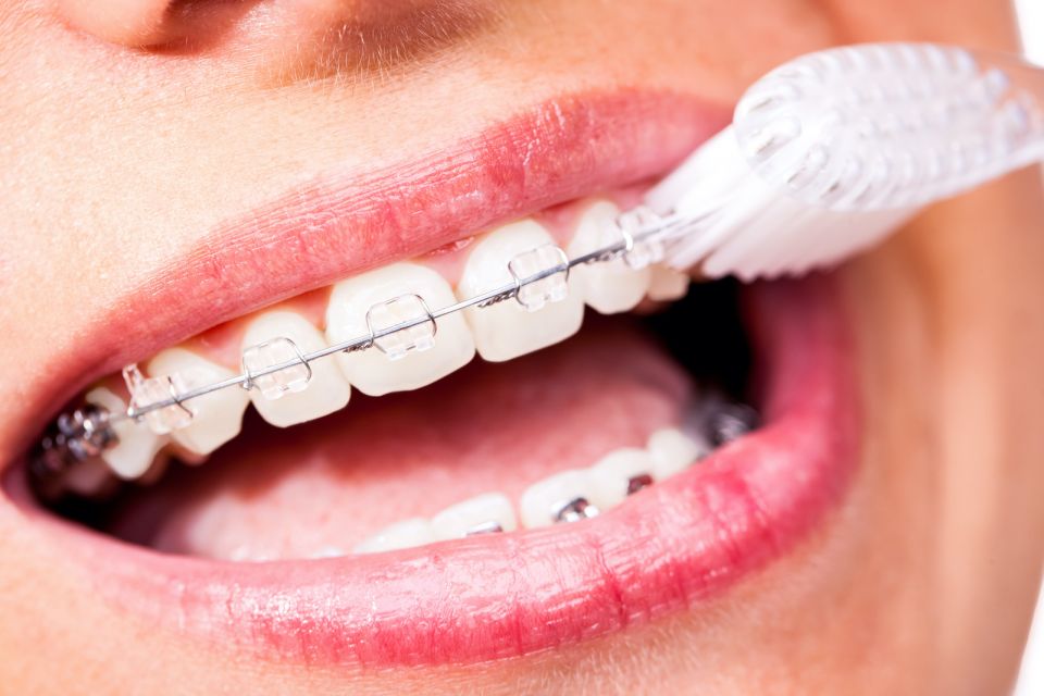 How to Keep Your Teeth Clean and Healthy While Wearing Houston Braces