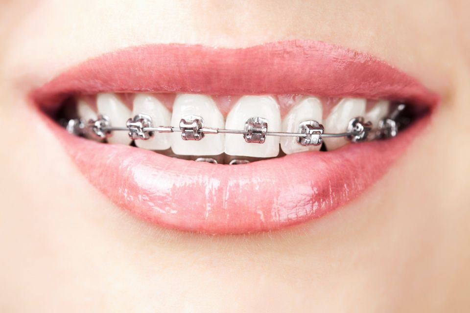 How To Get The Most Out Of Metal Houston Braces