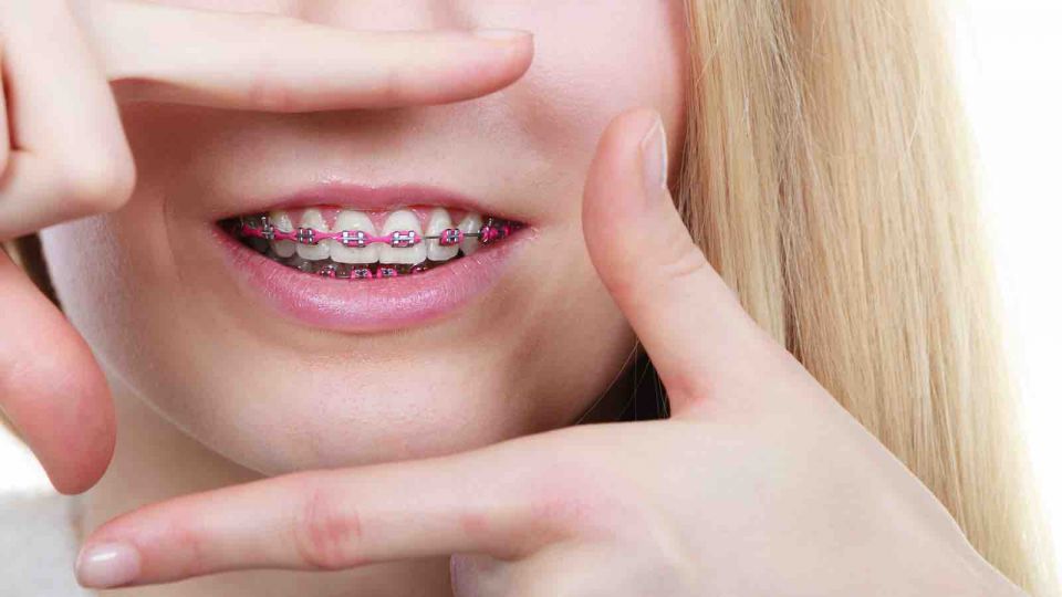 Launch Your Spring with Braces