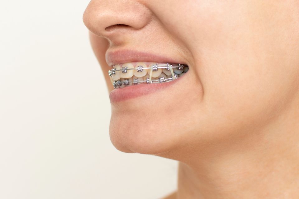 Do All Houston Braces Patients Have To Wear Rubber Bands?