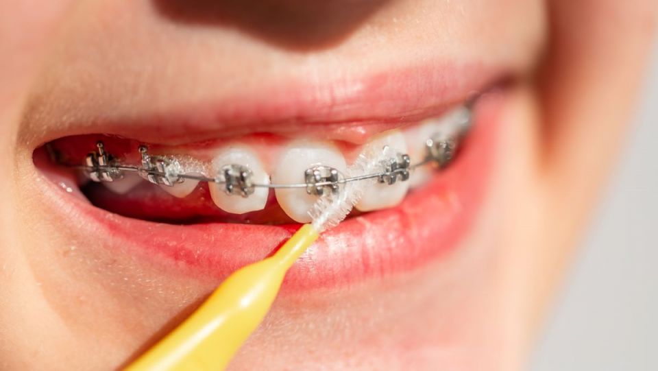 How to Keep Your Teeth Clean While Wearing Houston Braces