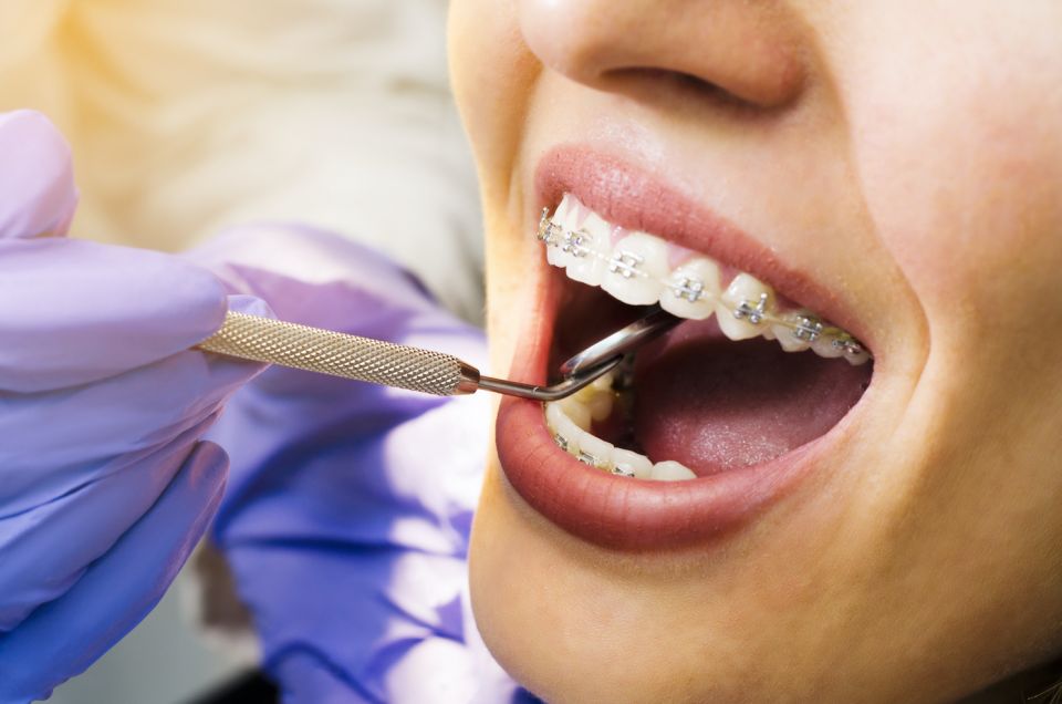 What to Expect When First Getting Dental Braces at Centra Dental in South Houston