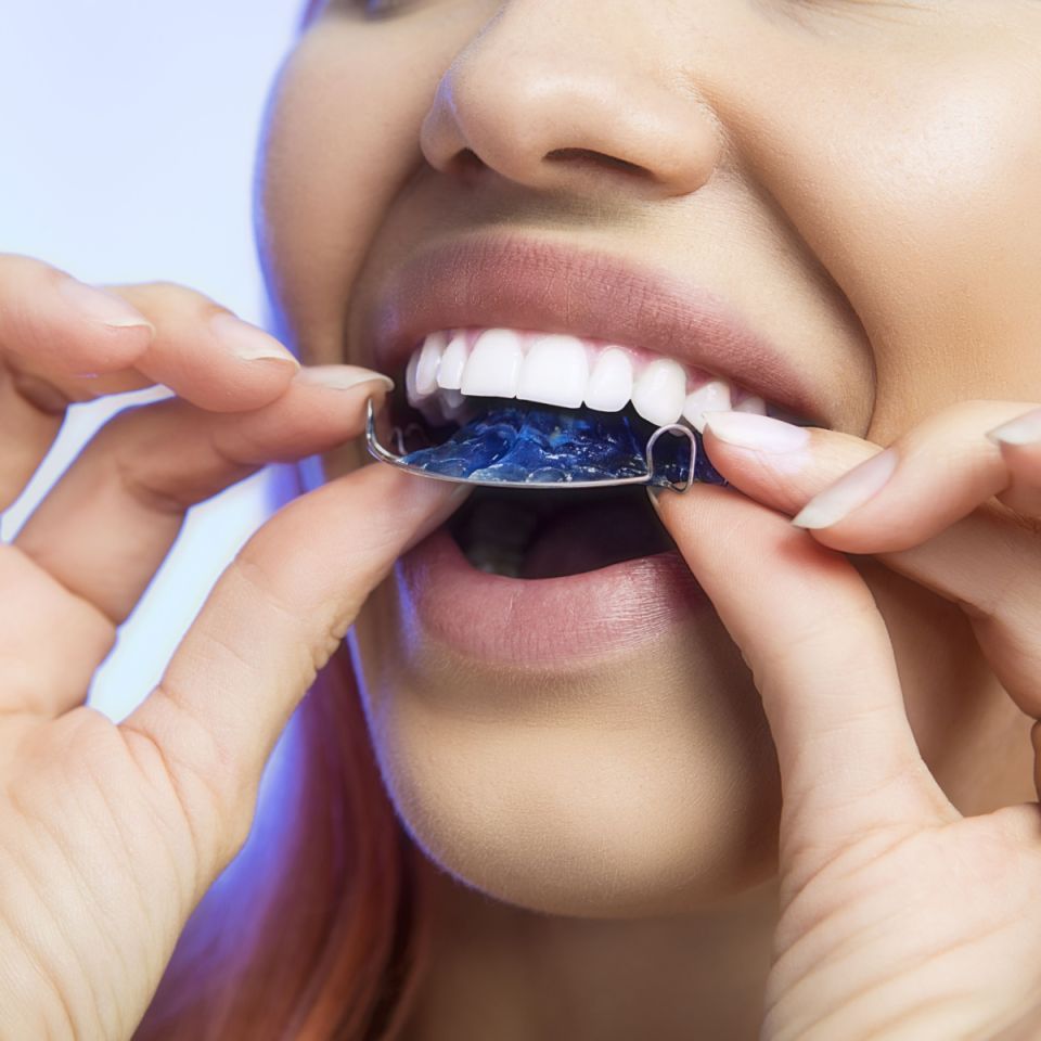 What Happens After You Get Your South Houston Braces Off? Tips on Maintaining Your New Smile