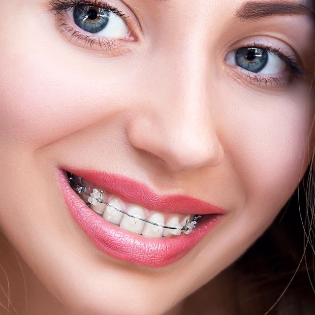 Ceramic Braces from your South Houston Dentist