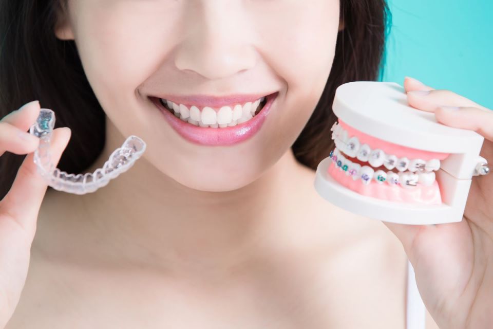 Different Types of South Houston Dental Braces