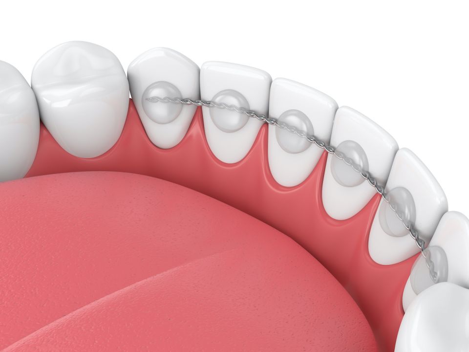 Pros and Cons of Bonded Orthodontic Retainers After Houston Braces