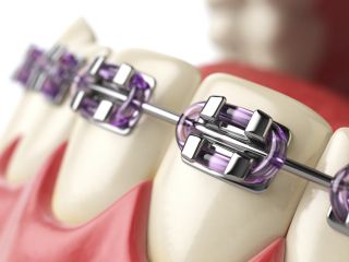 Which Is Better: Ceramic Or Metal Houston Braces?