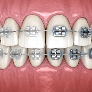 Are Metal South Houston Braces Better Than Ceramic?