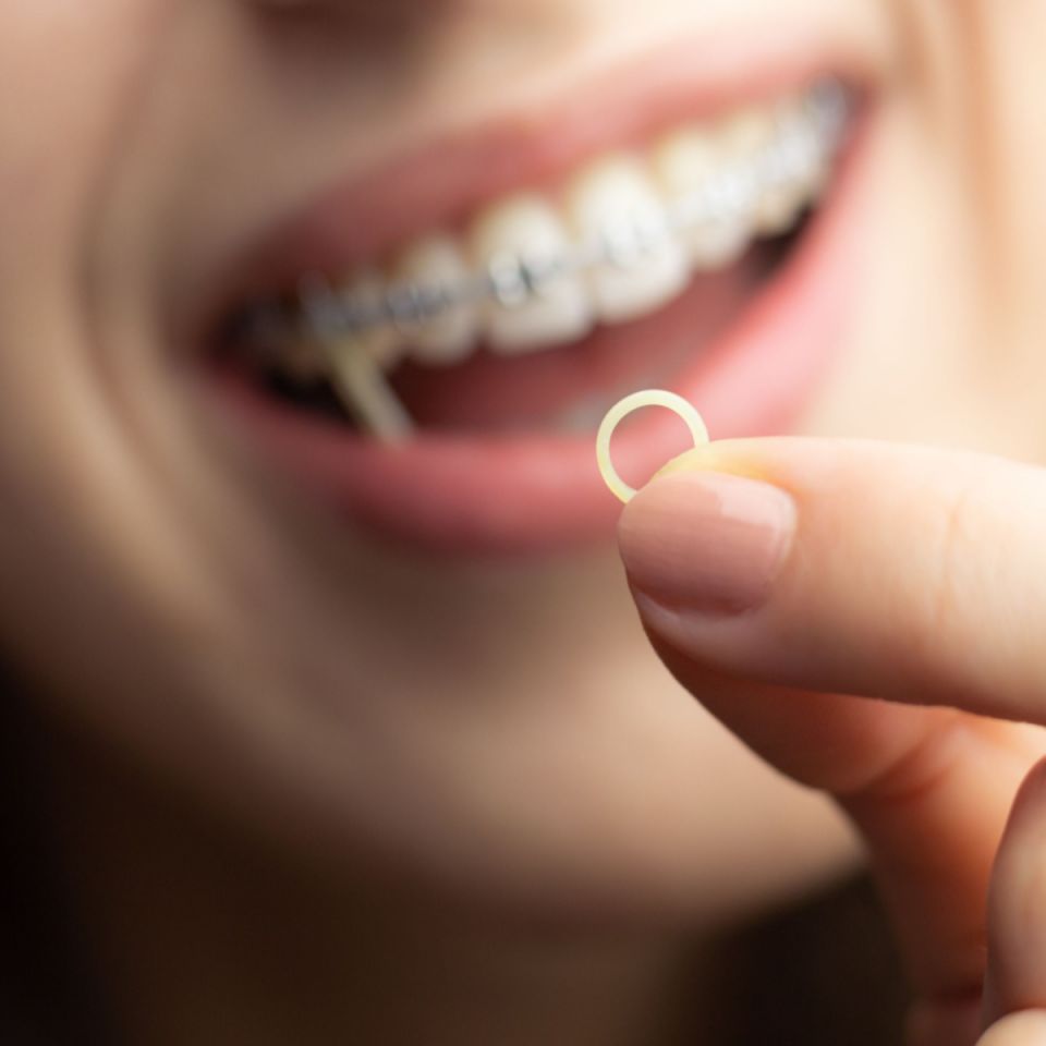 Do All Houston Braces Patients Need Rubber Bands?