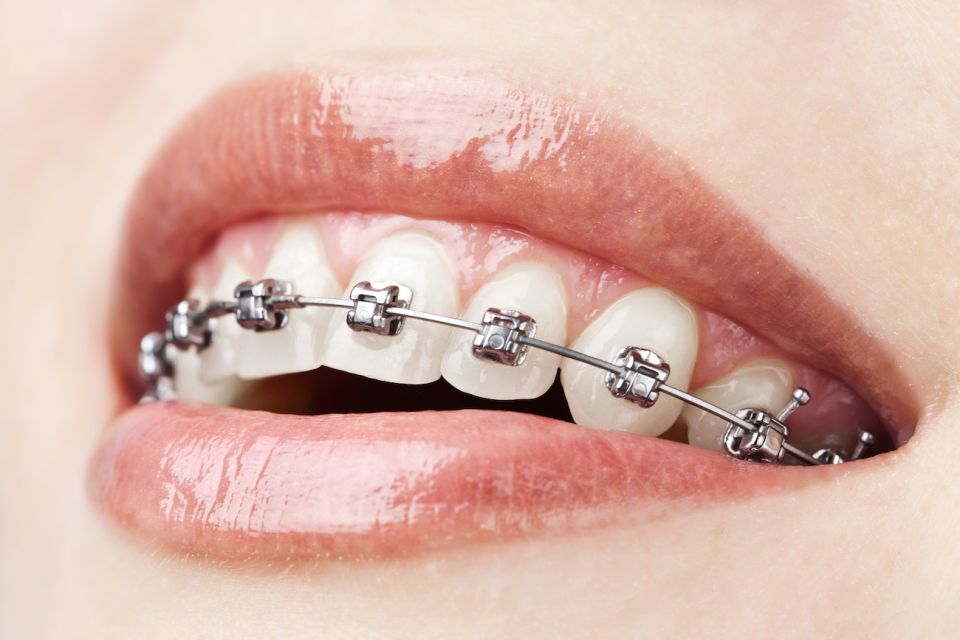 Correct Overbites With Metal Dental Braces At Our South Houston Dentist