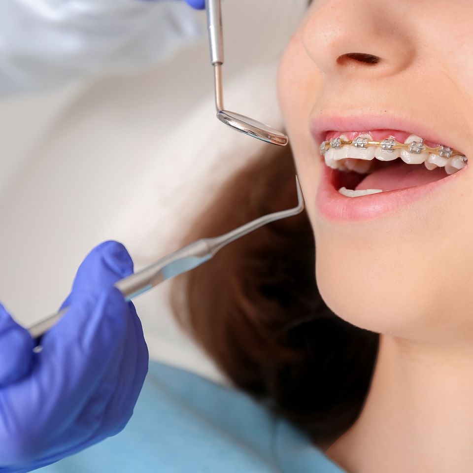 Dental Cleaning With Braces by a South Houston Dentist