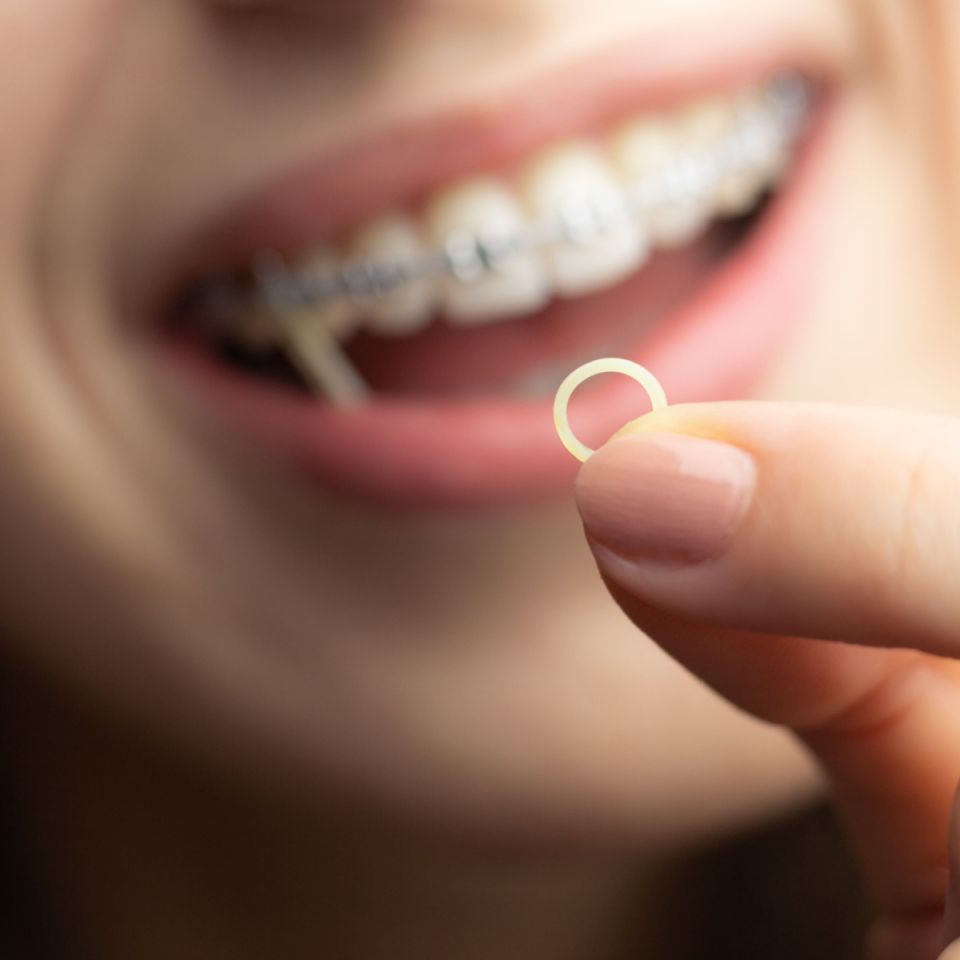 Why Are Rubber Bands Used in South Houston Braces Treatment?